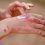 woman-applying-ointment-on-her-hands-in-the-treatment-of-psoriasis.jpg